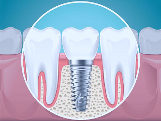Dental Implants Cost in NYCDr. Jacquie